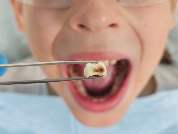 Best Urgent Care for Lost Fillings or Crowns in Melvindale, MI